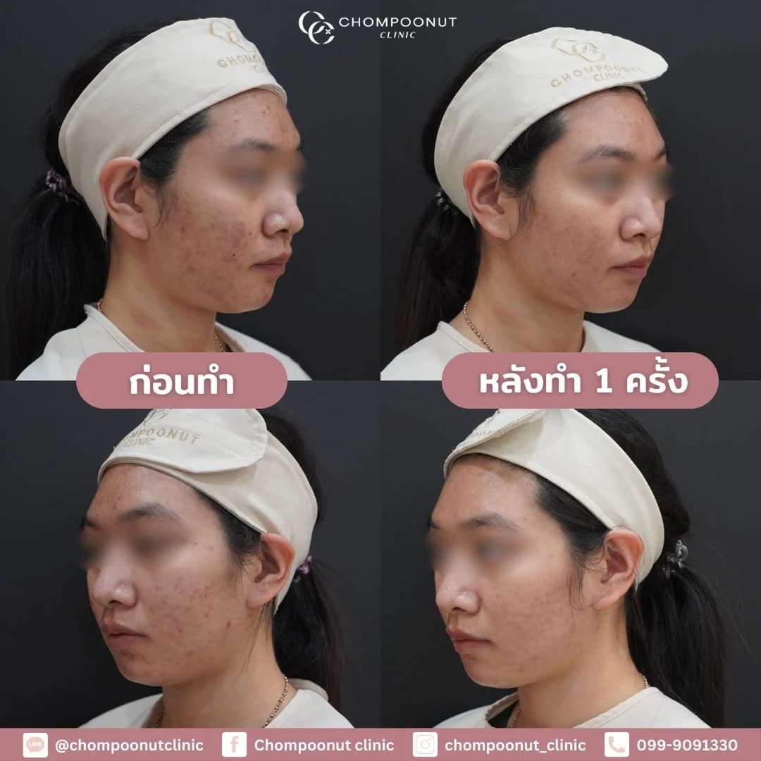 Review โปรแกรม สิว ฝ้า 1