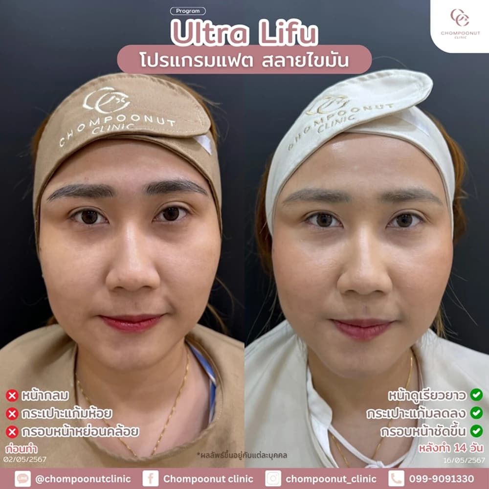 Review โปรแกรม Fat 1