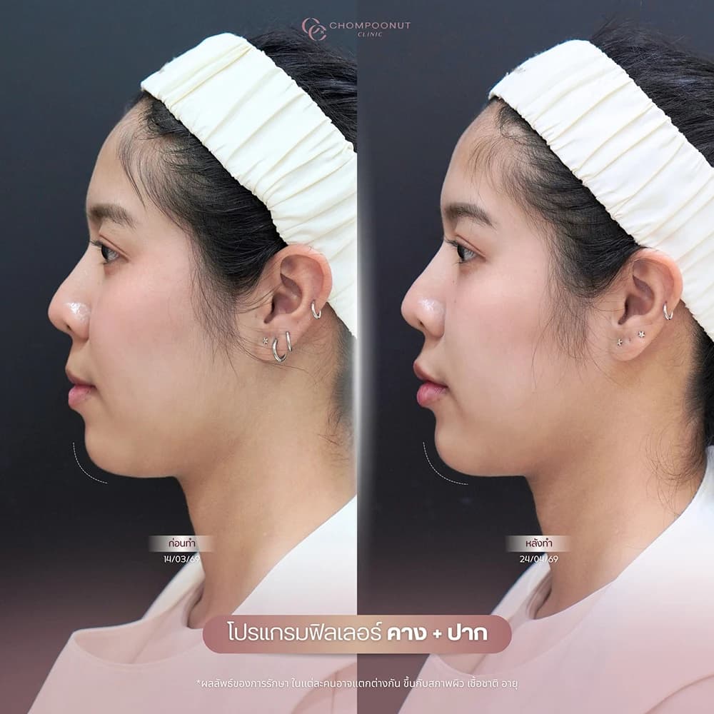 Review โปรแกรมฟิลเลอร์ 1