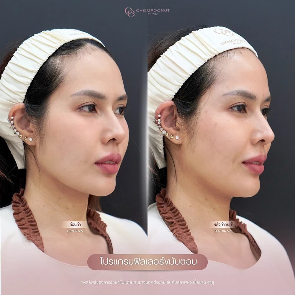 Review โปรแกรมฟิลเลอร์ 4