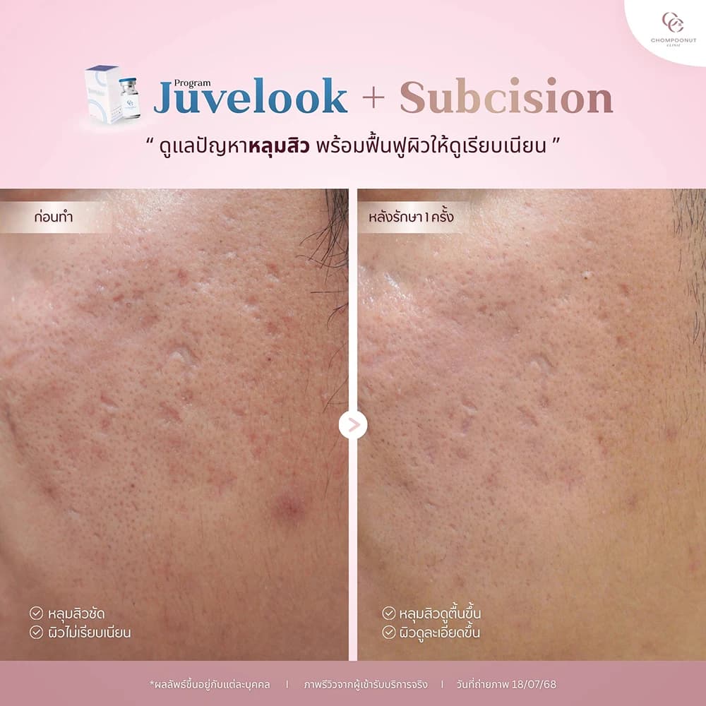 Review โปรแกรม Juvelook 1
