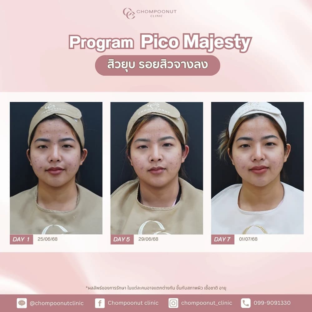 Review โปรแกรม Pico 1