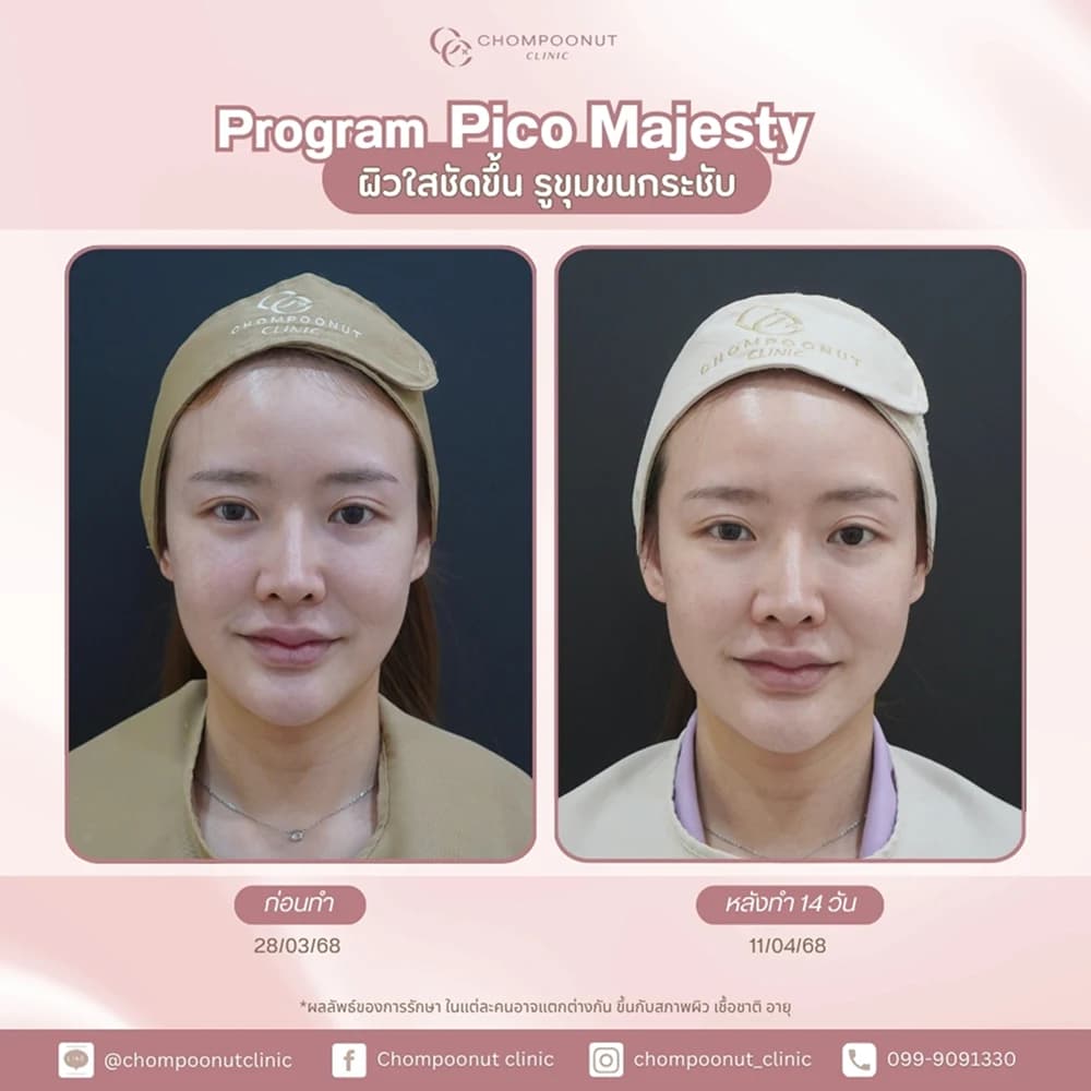Review โปรแกรม Pico 3