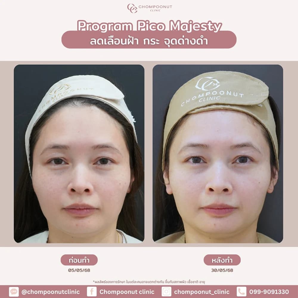 Review โปรแกรม Pico 5