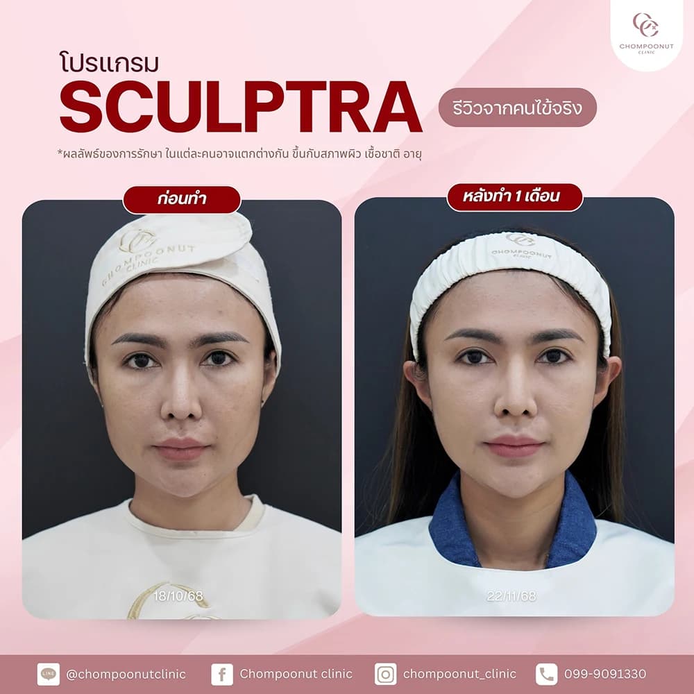 Review โปรแกรม Sculptra 1