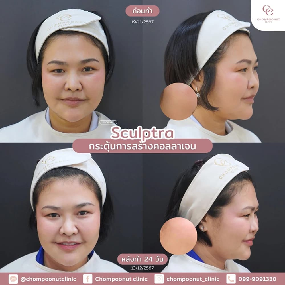 Review โปรแกรม Sculptra 2