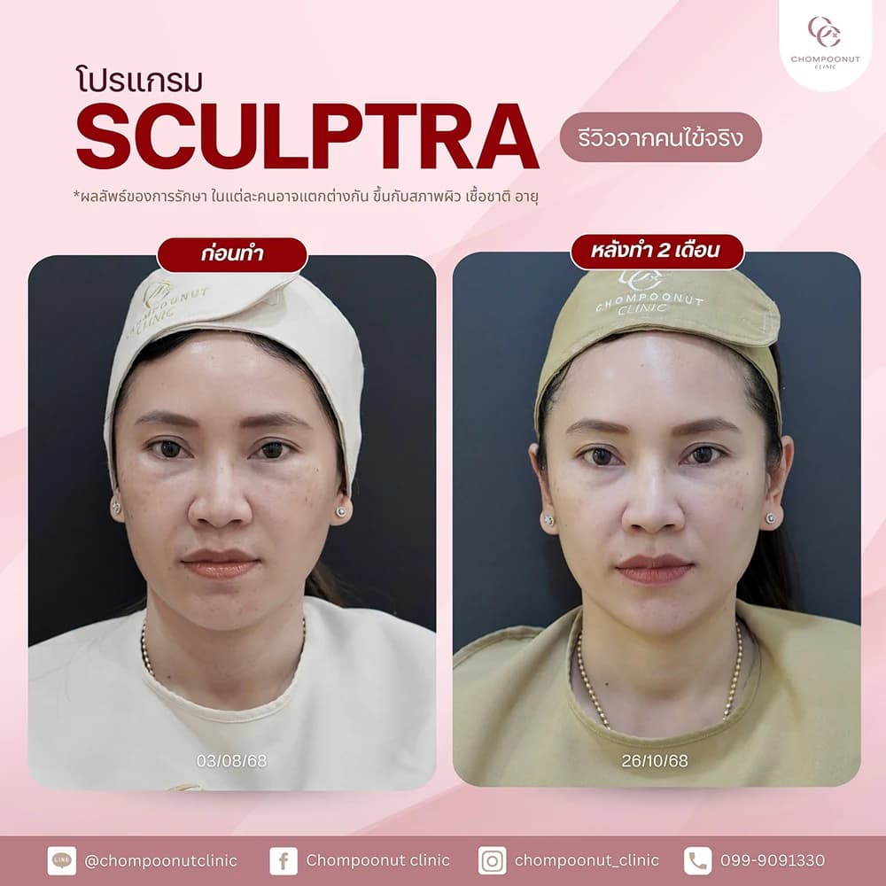 Review โปรแกรม Sculptra 5