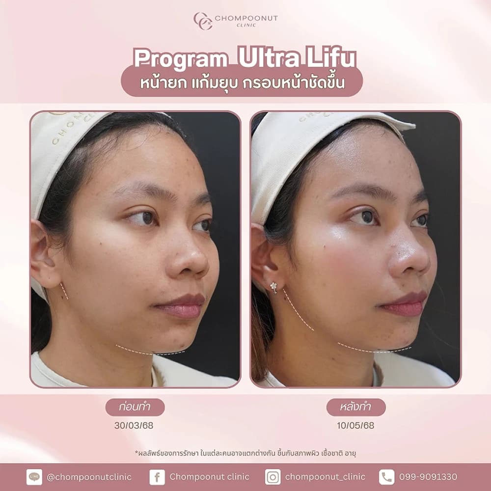 Review โปรแกรม Ultra Lifu 1