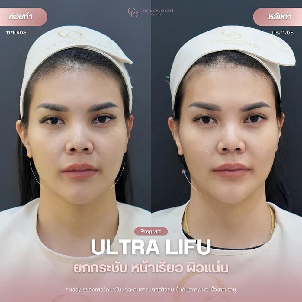 Review โปรแกรม Ultra Lifu 2