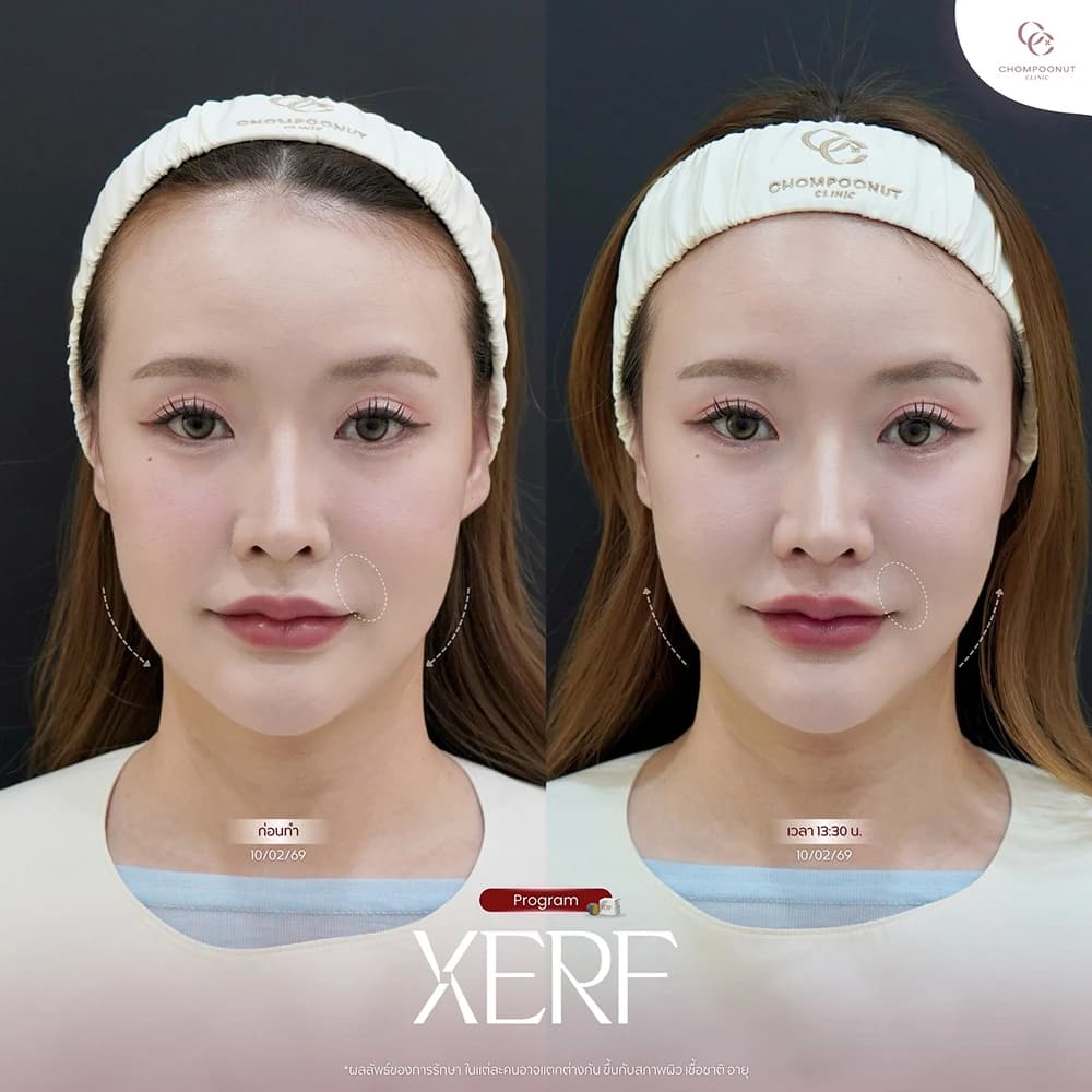 Review โปรแกรม XERF 1