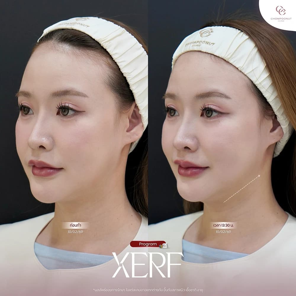 Review โปรแกรม XERF 2