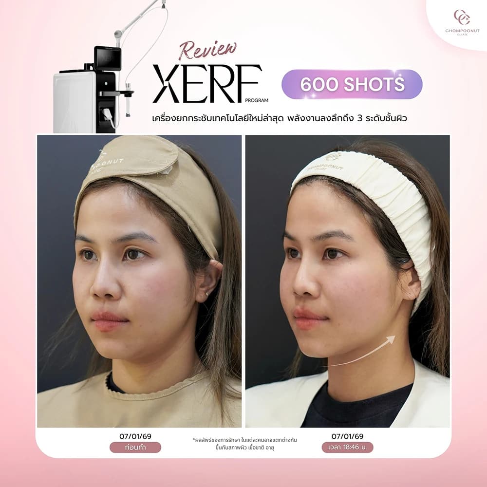 Review โปรแกรม XERF 4