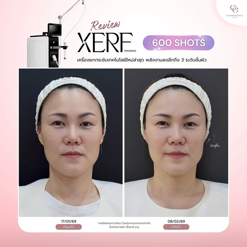 Review โปรแกรม XERF 5