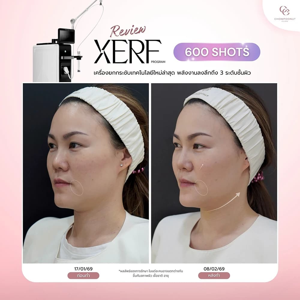 Review โปรแกรม XERF 6